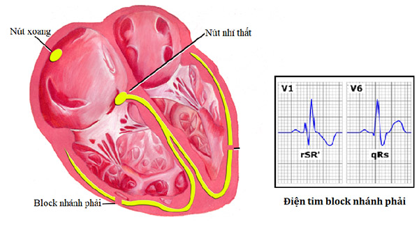 Hình ảnh mô tả bệnh block nhánh phải và điện tim block nhánh phải